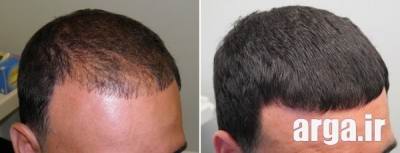 داروهای درمانی ریزش مو در مردان