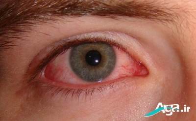 درمان التهاب و قرمزی چشم 