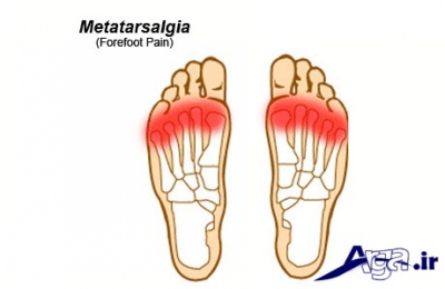 بیماری Metatarsalgia 