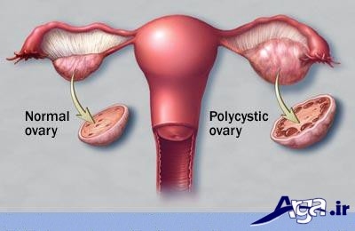 علایم تنبلی تخمدان در زنان