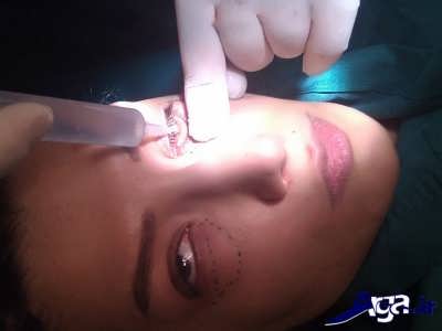 عمل جراحی درمان مناسب گودی زیر چشم