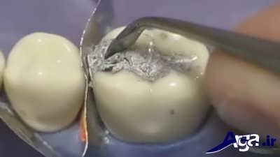 عصب کشی های دندان