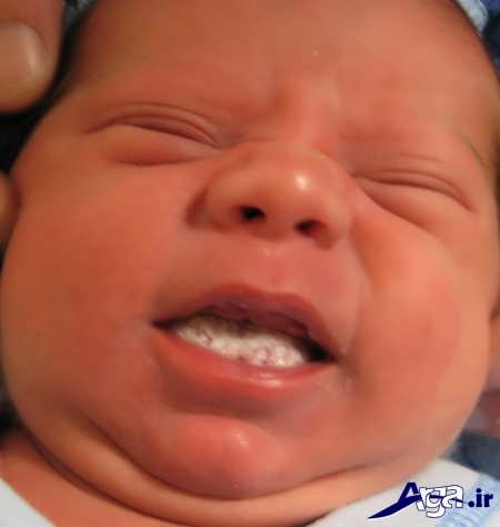 درمان و پیشگیری از برفک دهان نوزاد