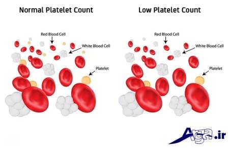 تفاوت پلاکت خون نرمال و کمبود