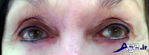تاتو کردن پلک چشم و عوارض ناشی از تاتو 
