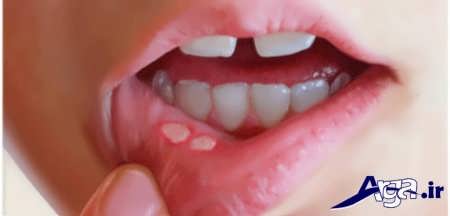 روش های خانگی درمان آفت دهان کودکان