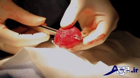 عمل جراحی برای درمان پروستات