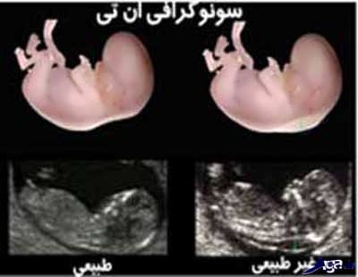 غربالگری سه ماهه اول بارداری