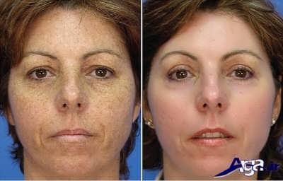 روش های طبیعی و خانگی برای درمان لک صورت 