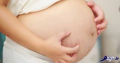 خارش پوست بدن در زنان بارداری