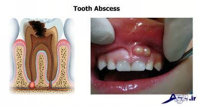 درمان آبسه دندان و لثه