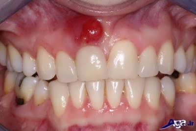 روش های درمان آبسه لثه و دندان