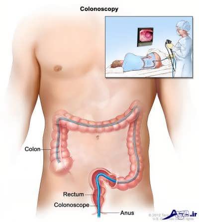 آزمایش کولونوسکوپی