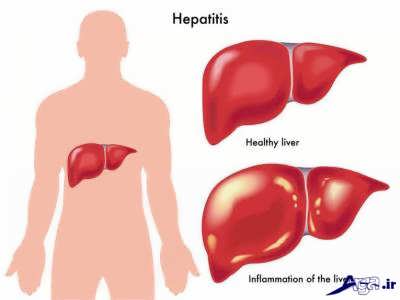 علایم و نشانه های هپاتیت