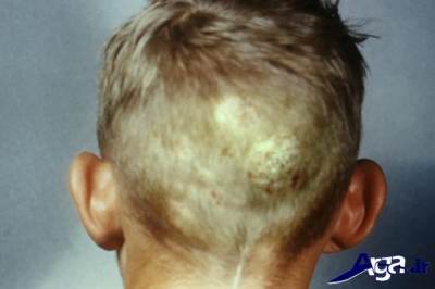 علتهای ریزش مو در کودکان