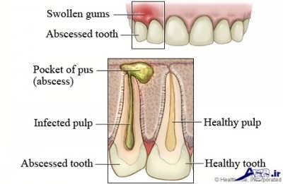 آبسه دندان و لثه چیست