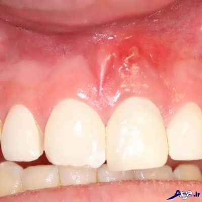 آبسه دندان و روش درمان آن