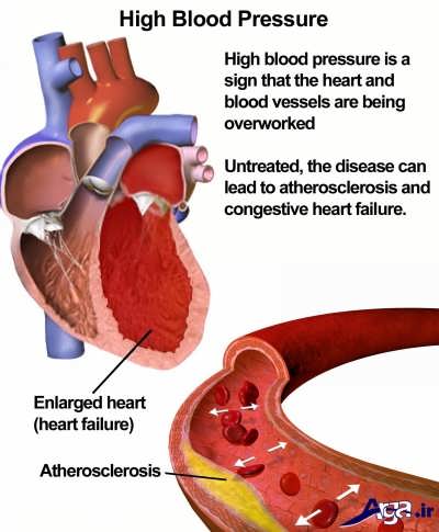 عوارض فشار خون بالا و غیر نرمال
