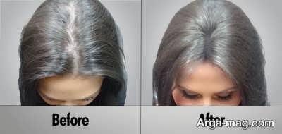 علت ریزش موی سر و موثرترین راه درمان آن
