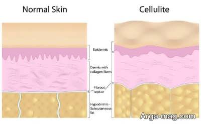 علایم و علل بروز سلولیت