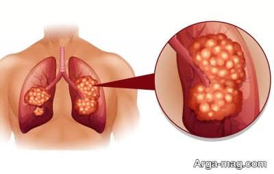 راه های درمان سرطان ریه 