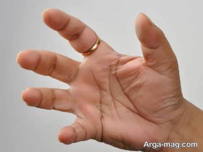 علائم ونشانه های درد انگشتان دست را بشناسید