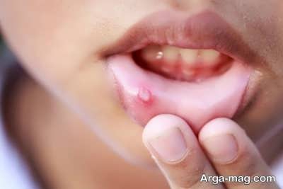 راه های درمان آفت خانگی دهان 