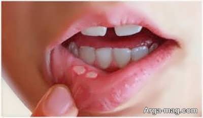 درمان آفت دهان در منزل با راه های طبیعی و خانگی