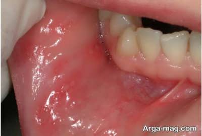 راه های درمانی آفت دهان در خانه