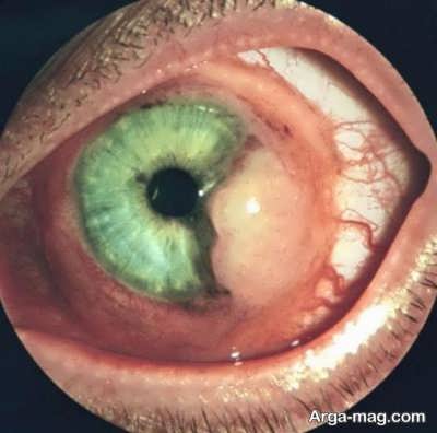 درمان تومور چشمی