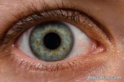 راه های تشخیص و درمان سوزش چشم