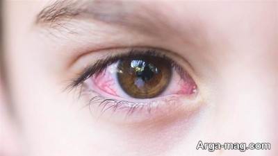 درمان سوزش چشمان