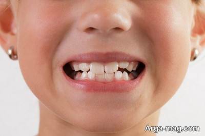 علت بروز دندان قروچه در کودکان و بزرگسالان