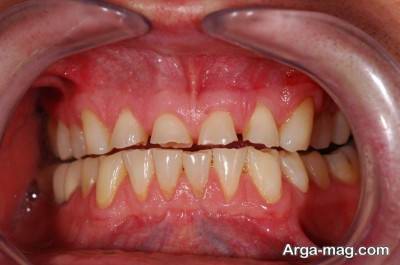 علل ایجاد دندان قروچه در بزرگسالان و کودکان 