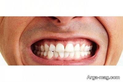 روش های درمان دندان قروچه 