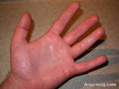 درمان عرق کردن کف دست