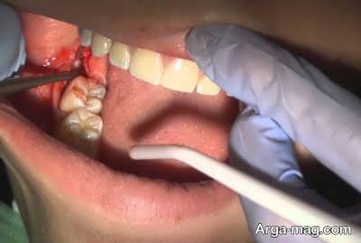راه های تسکین درد بعد از جراحی دندان عقل