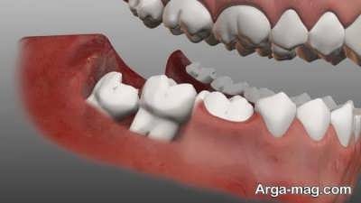 مراقبت های لازم بعد از انجام عمل جراحی دندان عقل