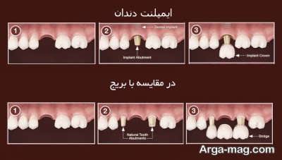مزایا و معایب روش بریج دندان