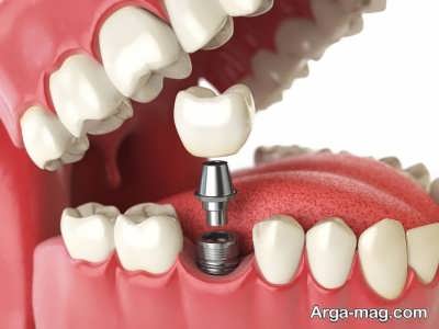 مزایا و معایب روش ایمپلنت دندان