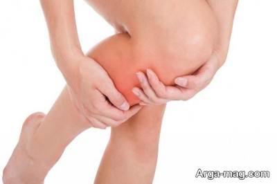 راه های درمان درد ساق پا