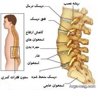 درمان قطعی دیسک کمر با ورزش