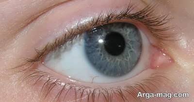راه های تشخیص تبخال چشم