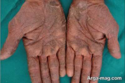  درمان حساسیت پوست دست
