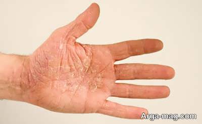 علت حساست های پوست دست