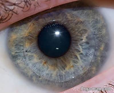 جراحی قرنیه چشم