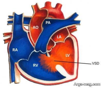 علائم سوراخ بین دو بطن قلب نوزاد