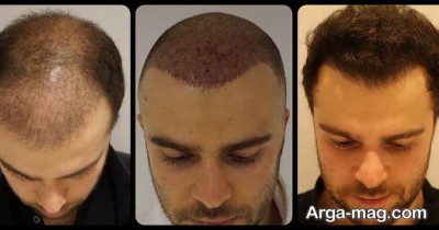 تصویر کاشت مو قبل و بعد از عمل