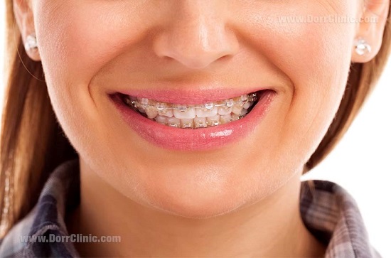فواید ارتودنسی در دهان و دندان