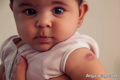 واکسن BCG برای مقابله و پشگیری از سل